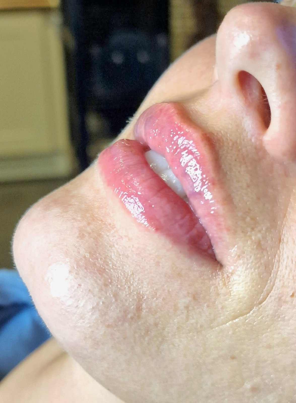 Lip filler result