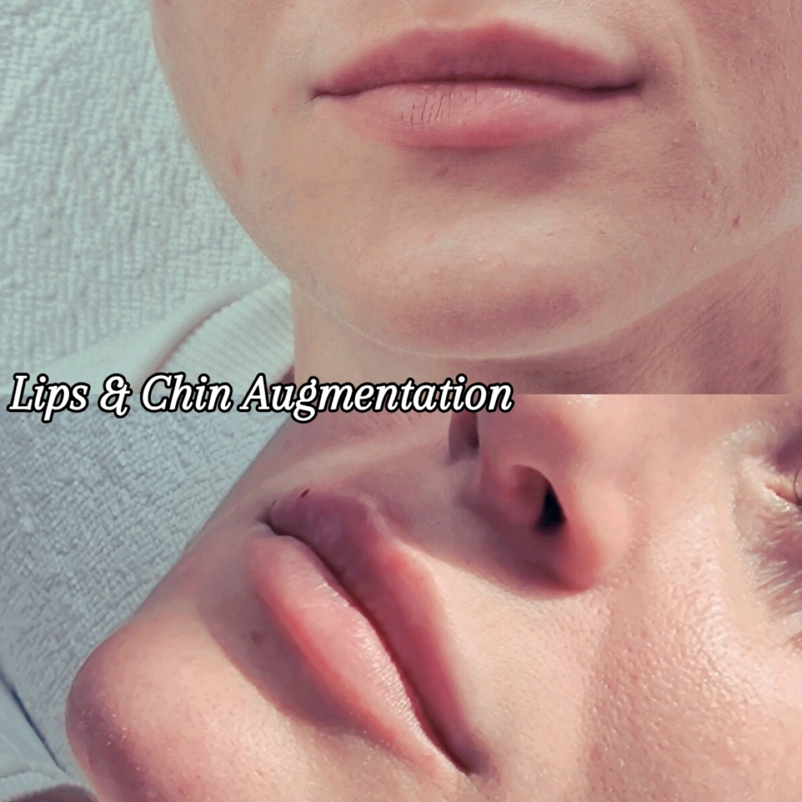 Lips and chin augmentation