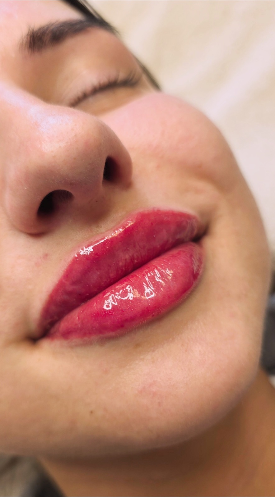 Lip enhancement