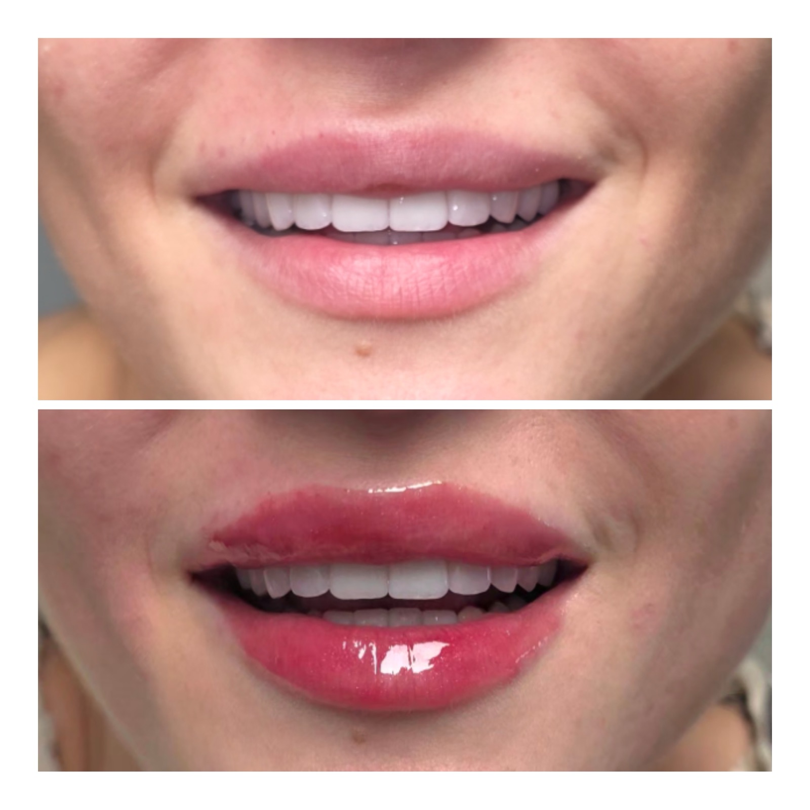 Microneedling